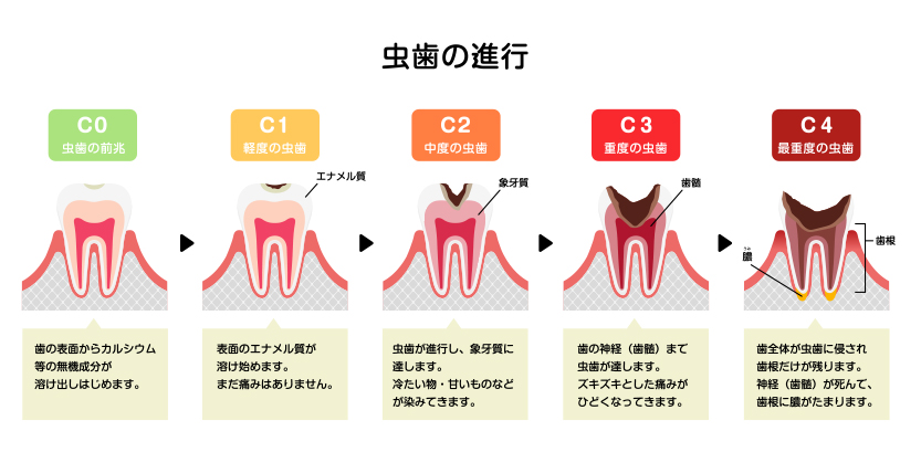 虫歯の進行