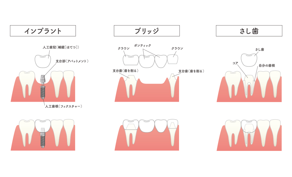 インプラントと従来の治療の違い